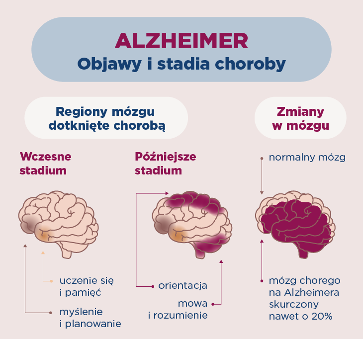Alzheimer – objawy w kolejnych stadiach choroby