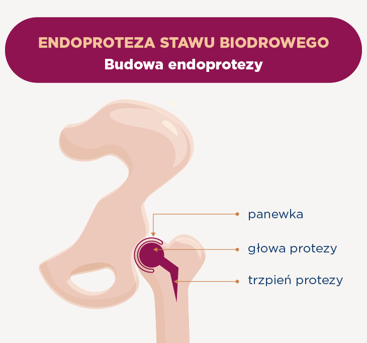 Budowa endoprotezy stawu biodrowego
