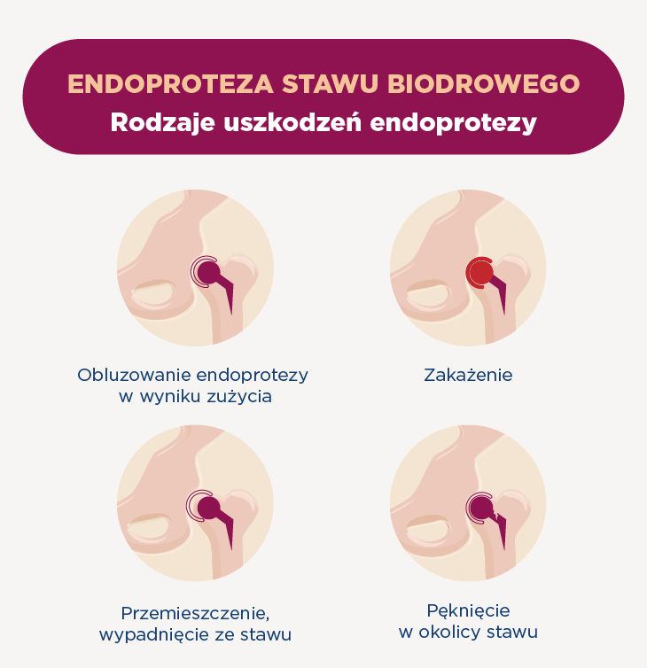 Rodzaje uszkodzeń endoprotezy stawu biodrowego