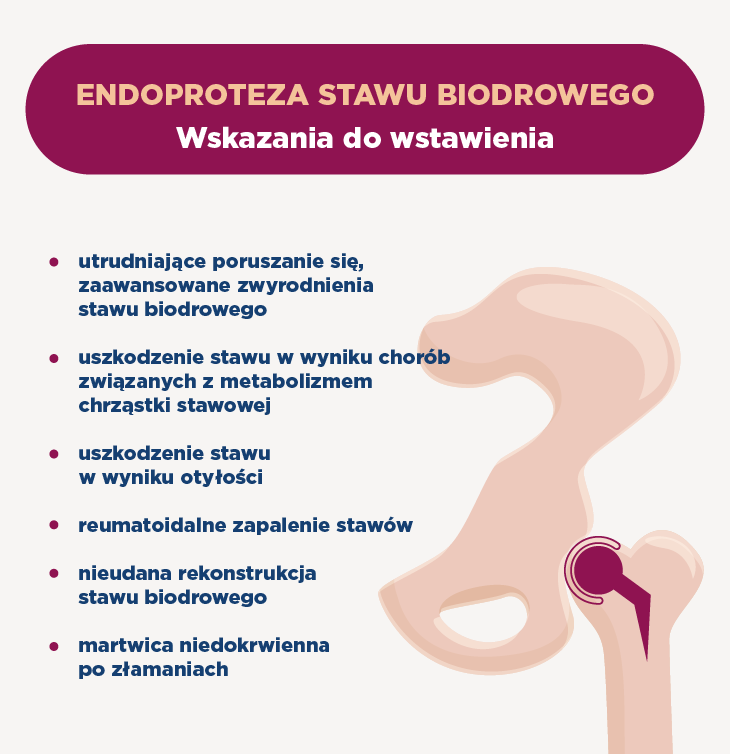 Endoproteza stawu biodrowego – wskazania do zabiegu