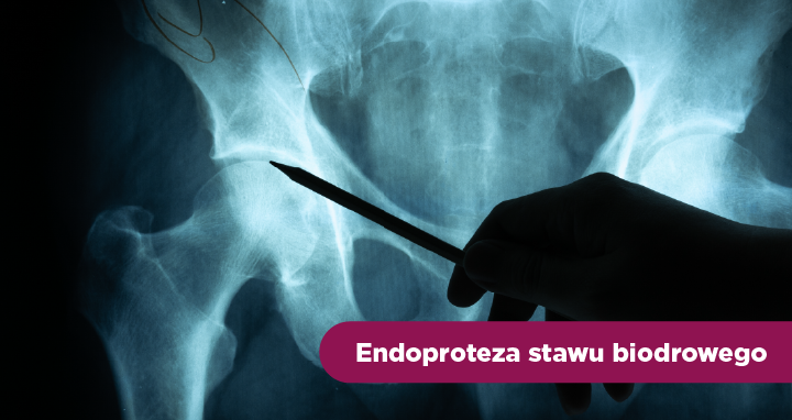 Endoproteza stawu biodrowego