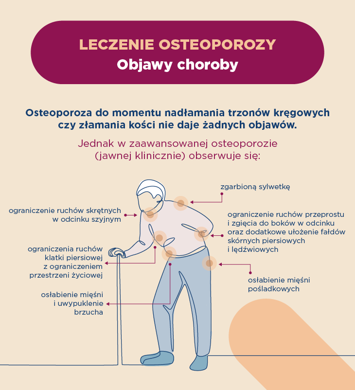 Leczenie osteoporozy – objawy choroby