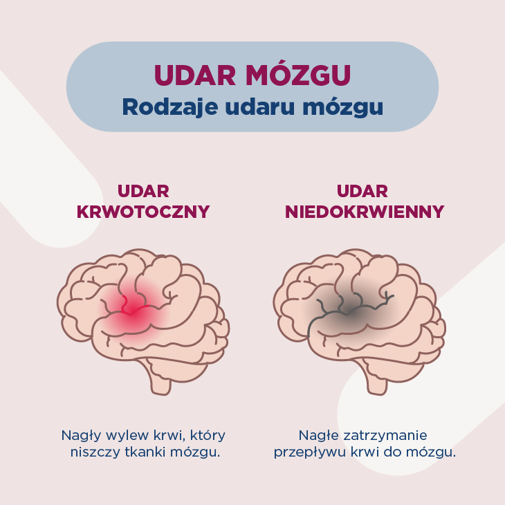 Udar mózgu – objawy i rodzaje udaru